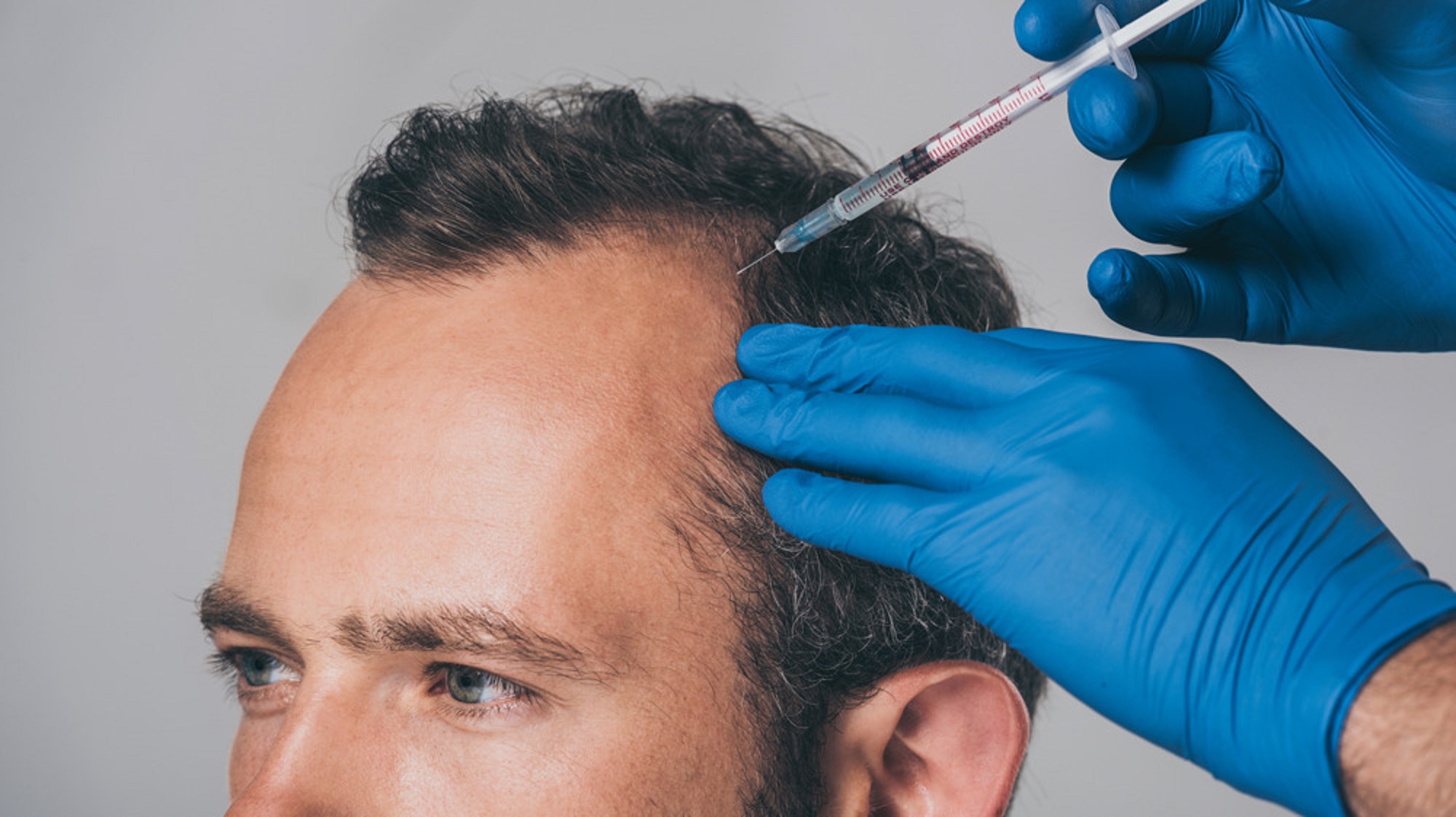 TERAPIA CAPILAR IMAGEN HOMBRE 4